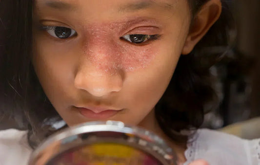 More than Fine: The emotional toll of living with Eczema