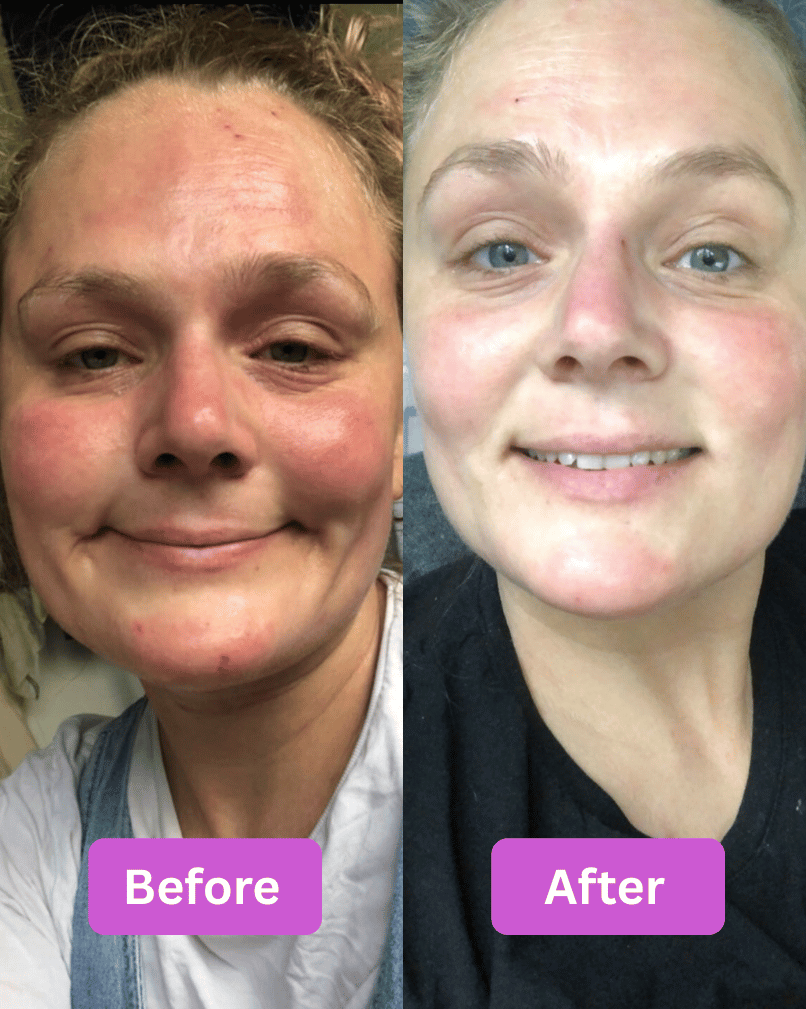 Before and after comparison of a person's face with visible eczema skin improvement.